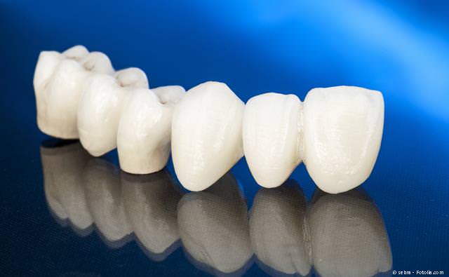 Die Vorteile von Zahnbrücken